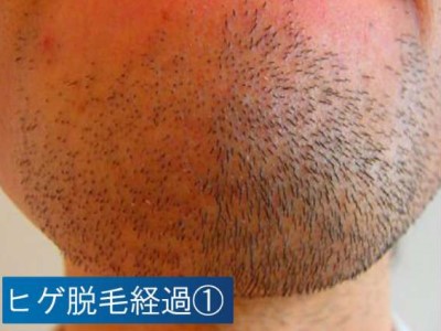 脱毛 姫路 メンズ脱毛 ヒゲ脱毛は男性専門cocolea Homme ココレアオム