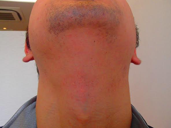 365日後のアゴ裏脱毛効果