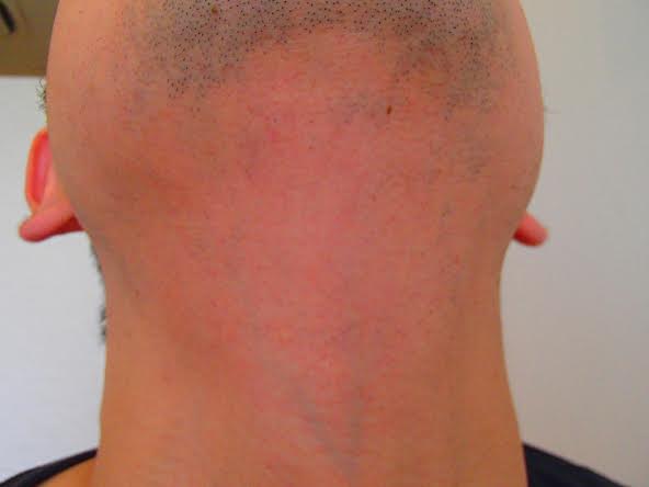 当サロンでの脱毛効果