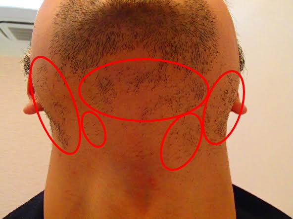 他のサロンでの抜け残り(アゴ裏)