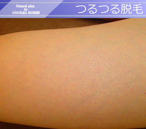 つるつる脱毛1