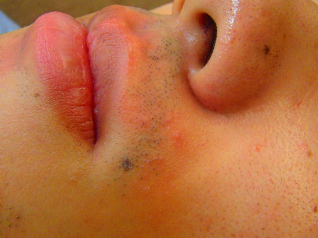 鼻下ヒゲ 脱毛前