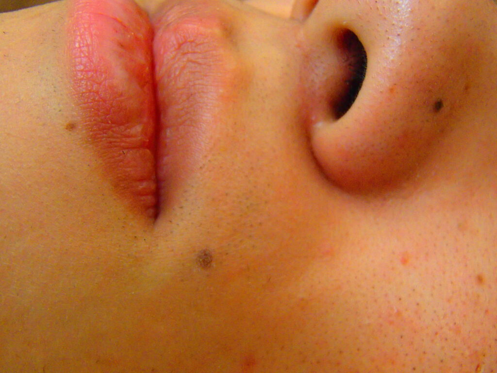 鼻下ヒゲ 脱毛後