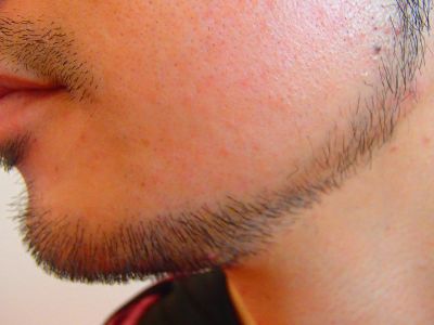 あごヒゲ デザイン脱毛後