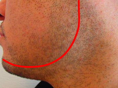 あごヒゲ ほほ デザイン脱毛前