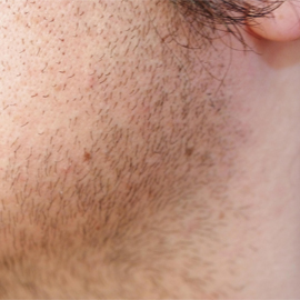 ひげ もみあげ 首 施術前