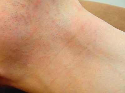 ヒゲ脱毛後(肌荒れ改善)