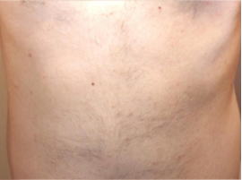 おなか 1回目施術後