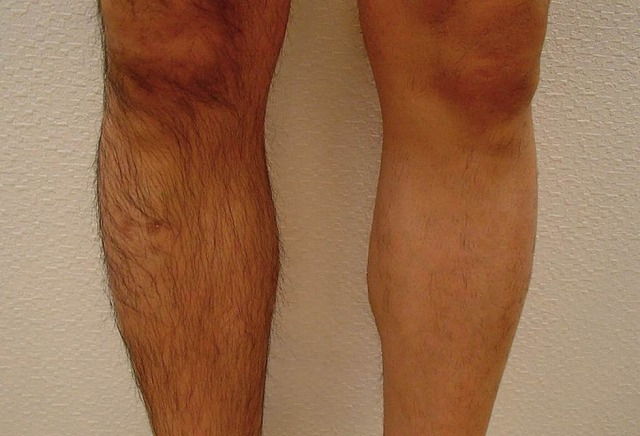 ひざ下施術1回(左足)