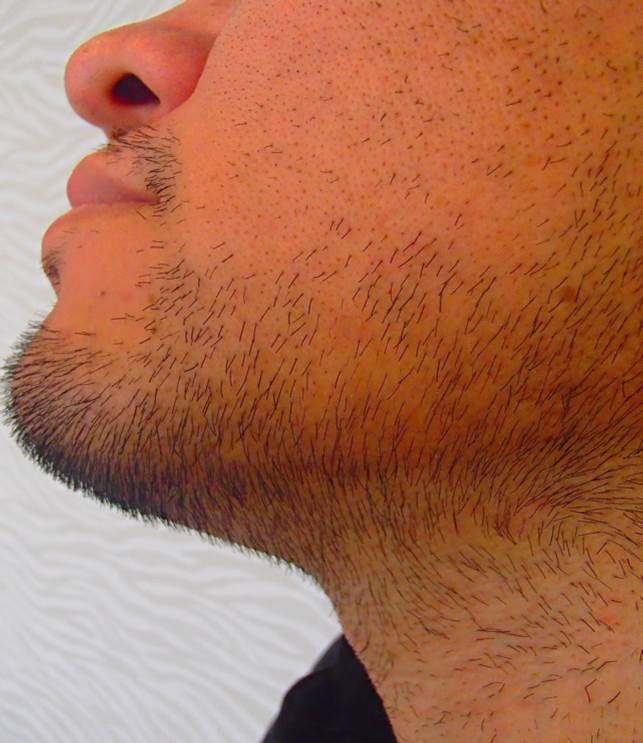 あご ほほ あご下 首 もみあげ 施術前