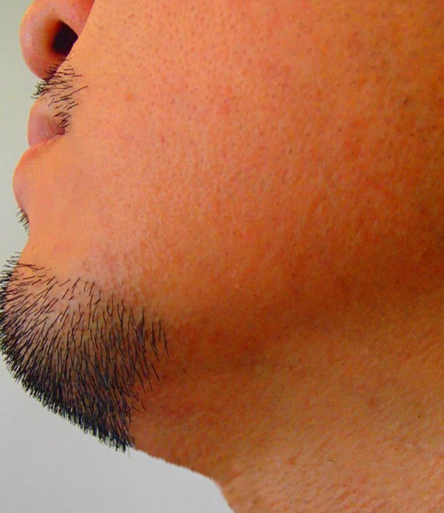 あごほほあご下首もみあげ施術後