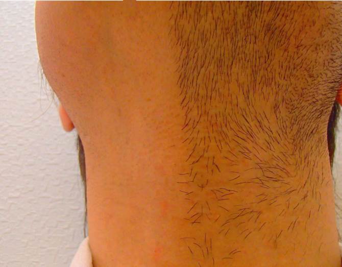 あご下 首半分 脱毛