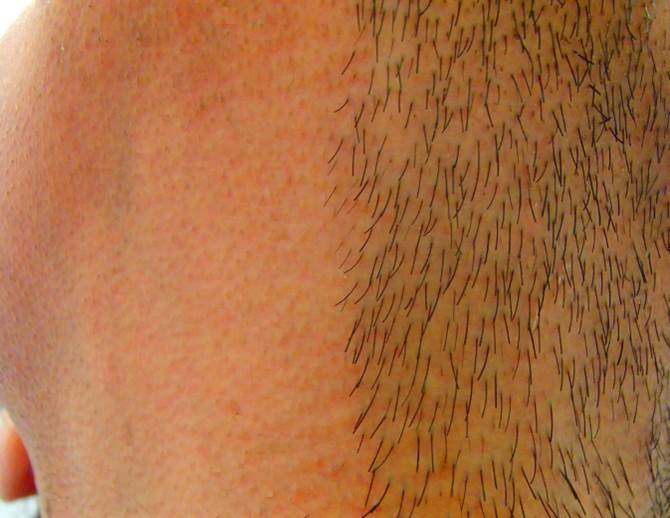 あご下 首半分 脱毛 アップ