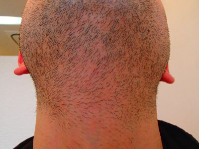 あご下 首脱毛前