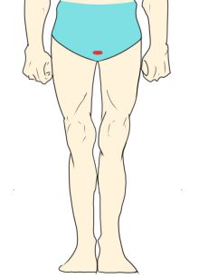 Iライン脱毛部位